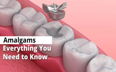 Amalgams: Everything you need to know